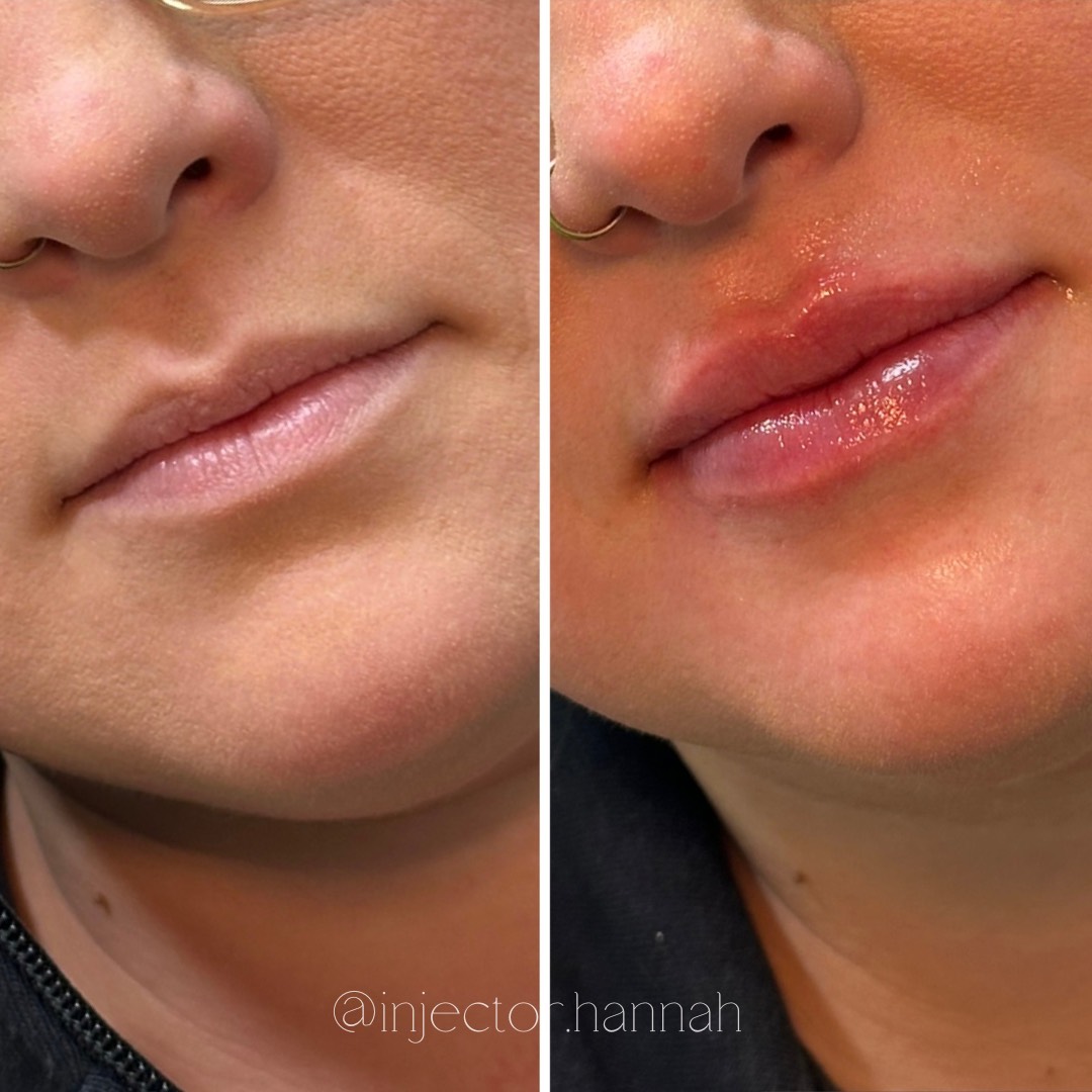 Forehead lines before/after – smoother after 2 weeks